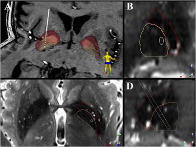 Modulation of Beta Oscillations in the Pallidum During Externally Cued Gait